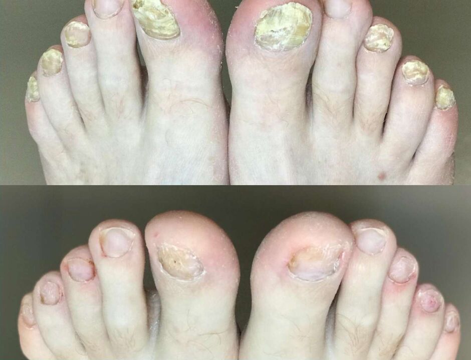 Vor und nach der Behandlung die Pilz -Promisil -Creme