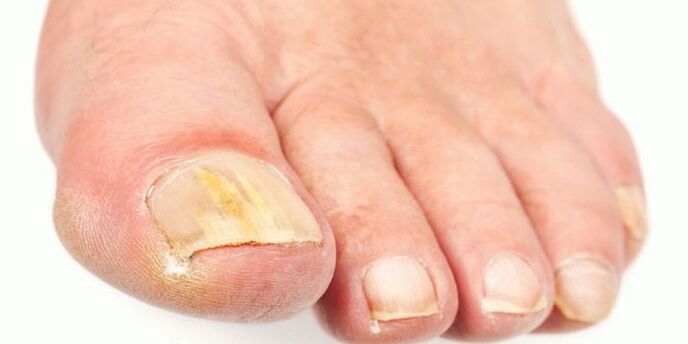 Wirksame Produkte aus Nagelpilz