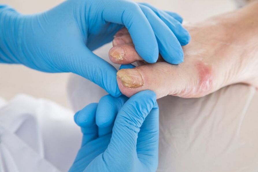 Von Pilzen befallene Nagelplatten
