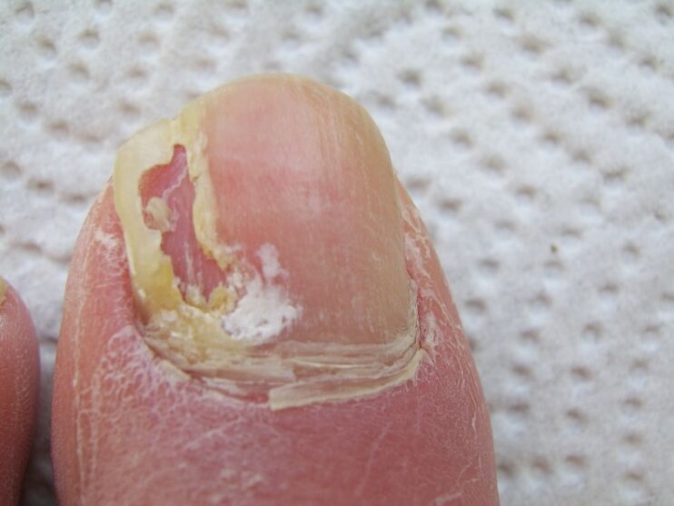 Bei der Onychomykose kommt es zu einer Verformung der Nagelplatte